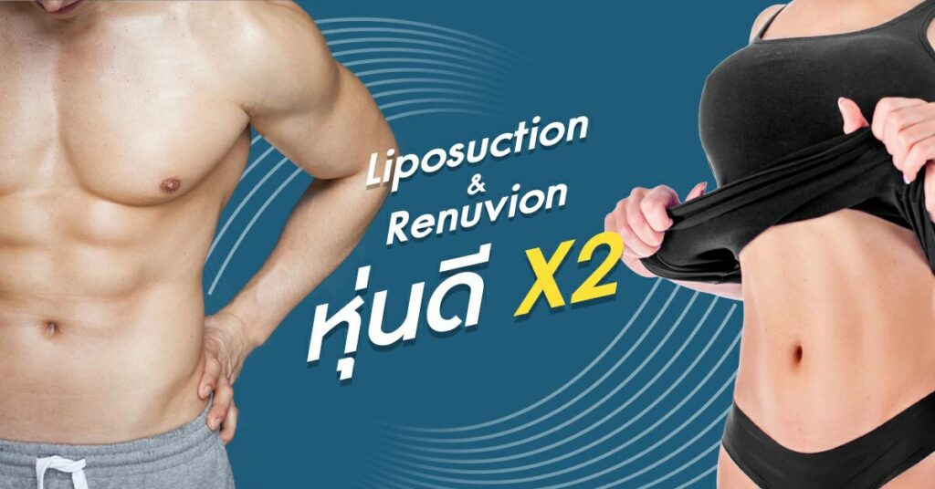 Liposuction-Renuvion